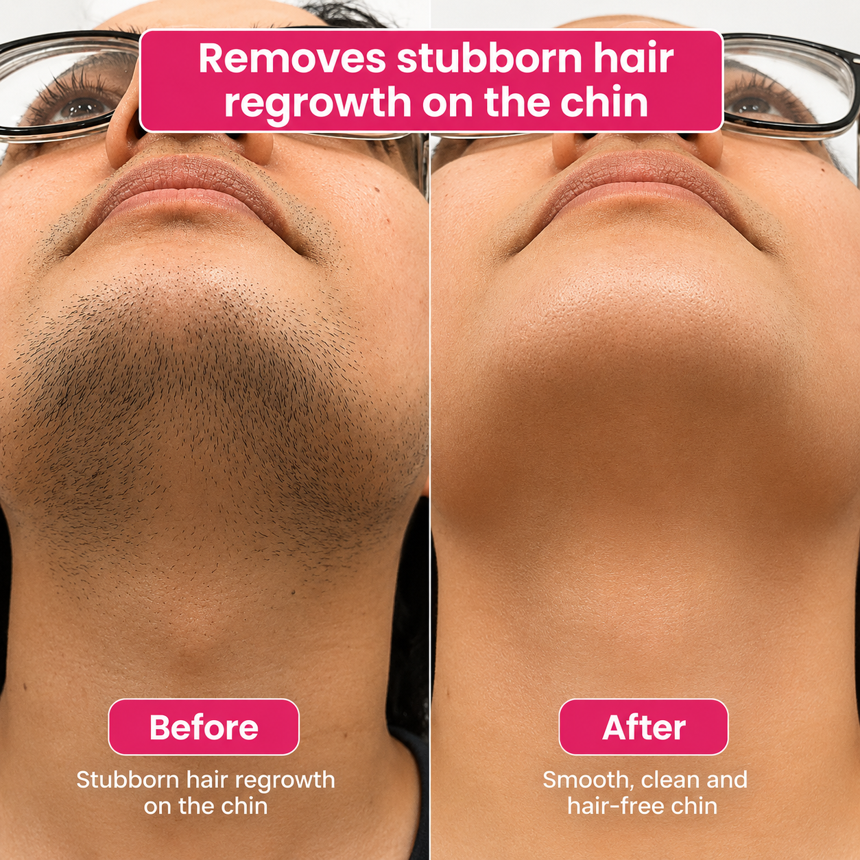 🔥LAST DAY 60% OFF Niteora Hair Reduction Oil 60 ml – Permanent Hair Removal Oil