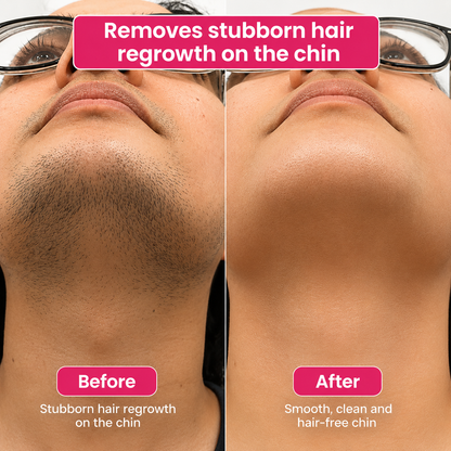 🔥LAST DAY 60% OFF Niteora Hair Reduction Oil 60 ml – Permanent Hair Removal Oil
